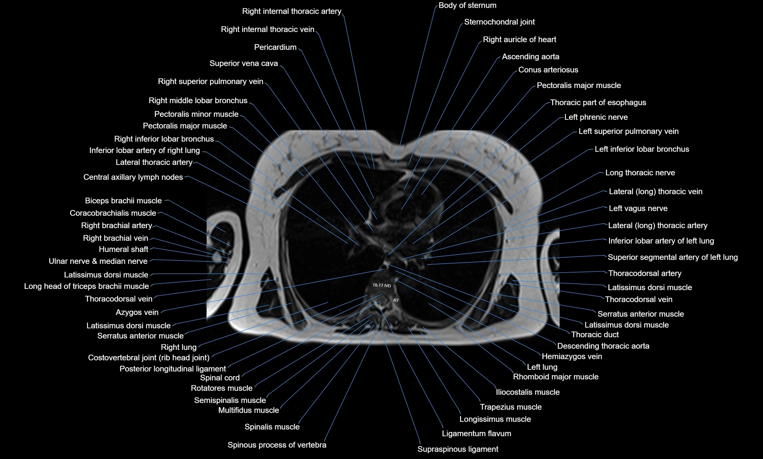 MRI chest axial  cross sectional anatomy 3T radiology  image-img-00001-00023.webp